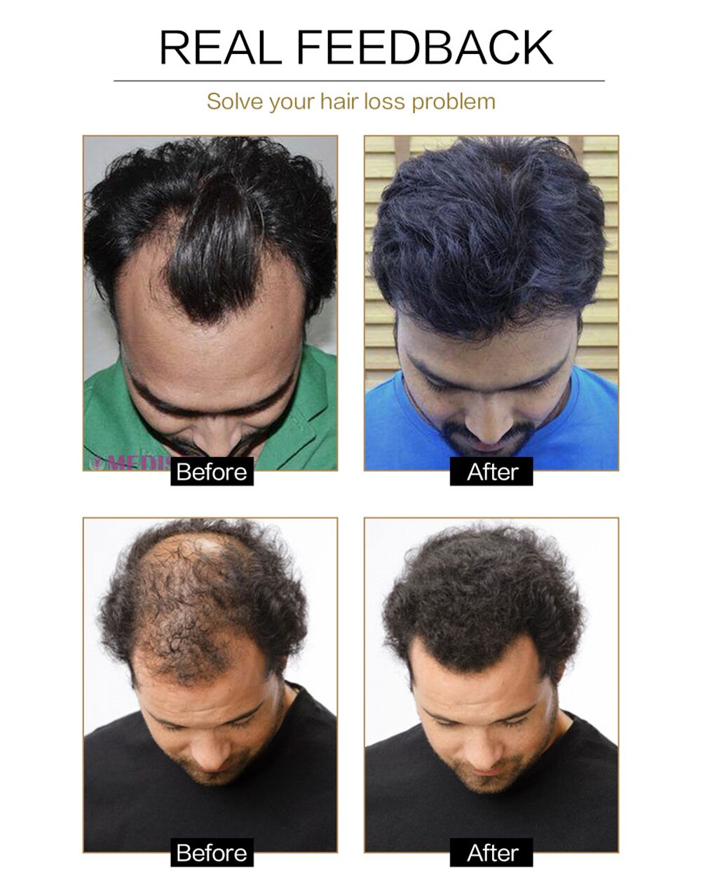 Head Scalp Massager Comb Neck Massage Roller Octopus Claws Magnetic Ball Relax SPA Hair Care for Hair Growth Stress Relief Rest